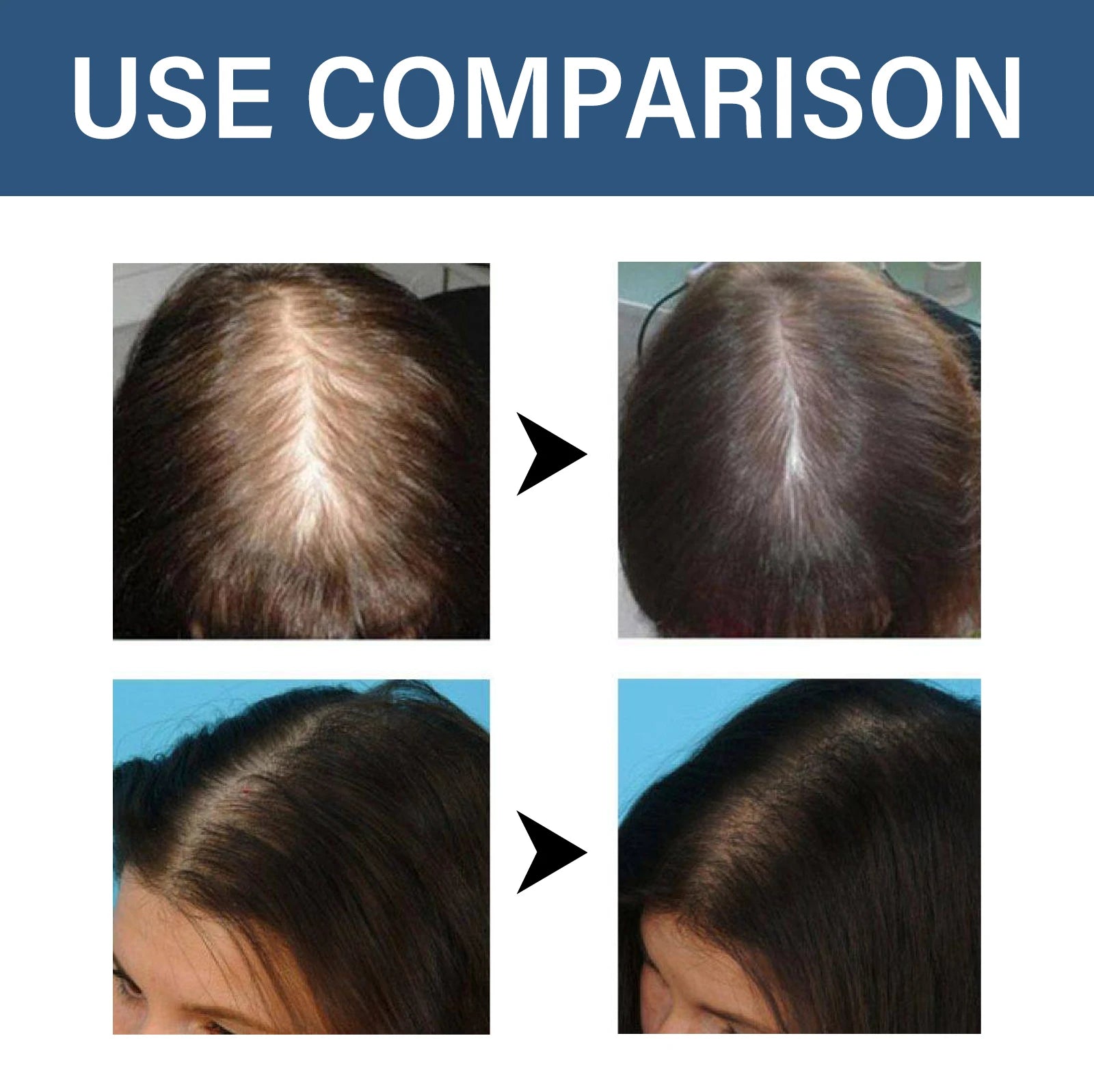 Hair Regrowth Capsules Thickens Accelerate Hair Growth in USA